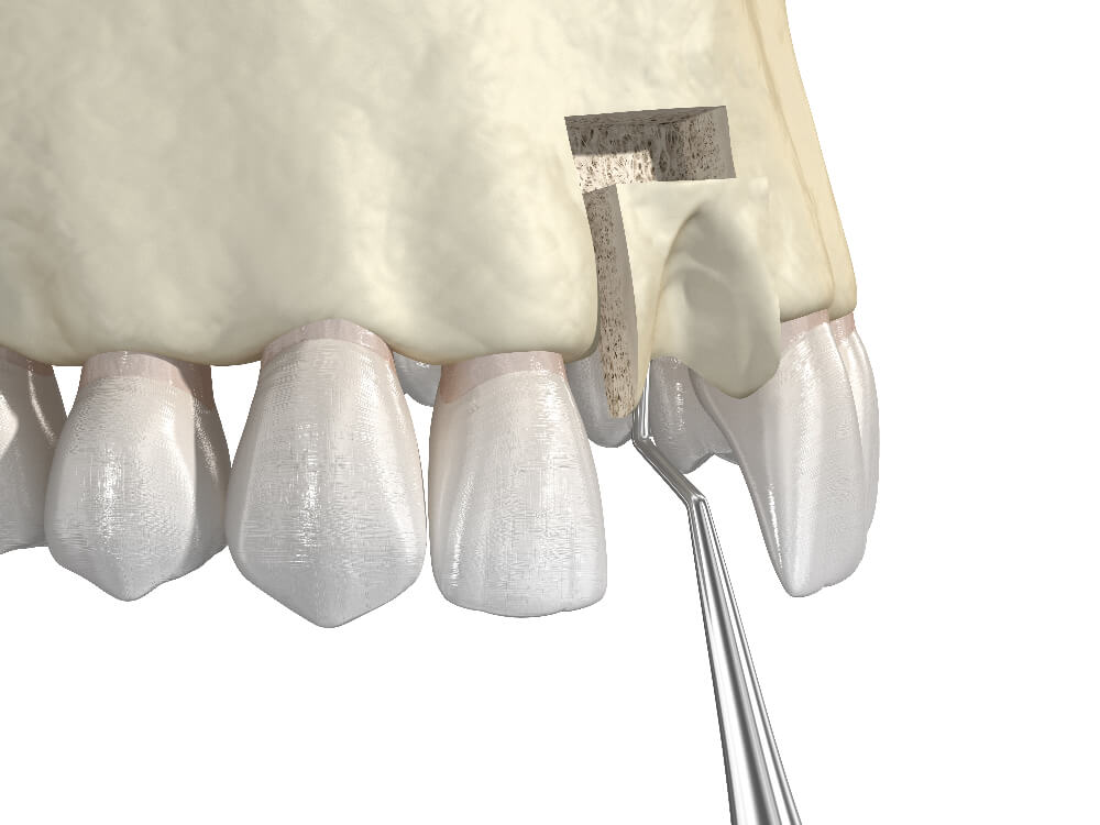 Bone Grafts - Tranquility Dental Arts, your Placentia Dentist