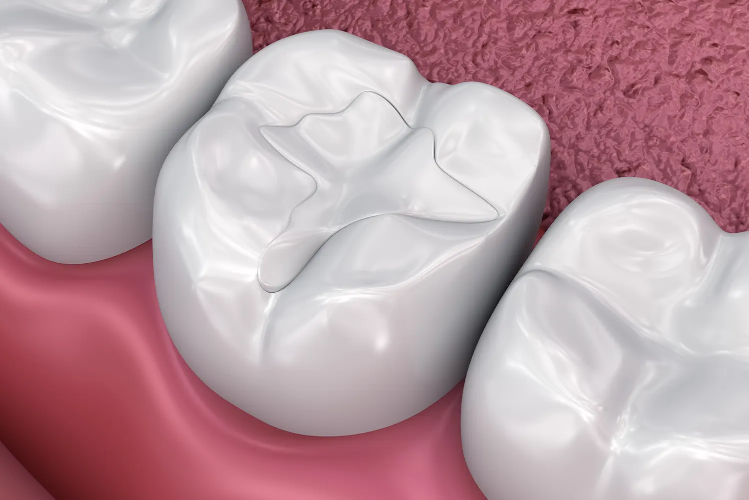 Dental Fillings - Tranquility Dental Arts, your Placentia Dentist