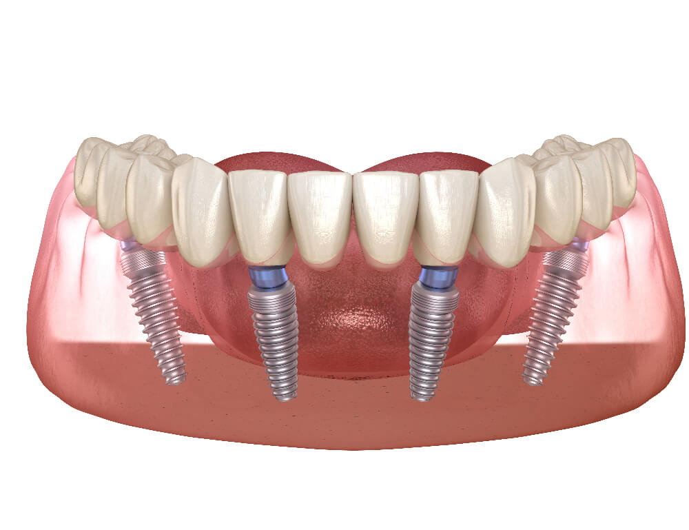 All-on-Four Implants - Tranquility Dental Arts, your dentist in Placentia, CA