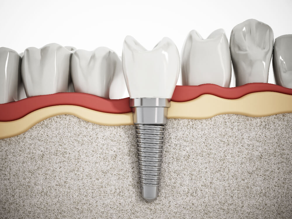Dental Implants in Placentia - Tranquility Dental Arts, your Placentia dentist