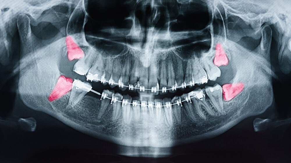 Wisdom Teeth Removal in Placentia - Tranquility Dental Arts, your Placentia dentist