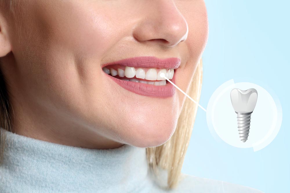 Dental Implants in Placentia - Tranquility Dental Arts, your Placentia dentist