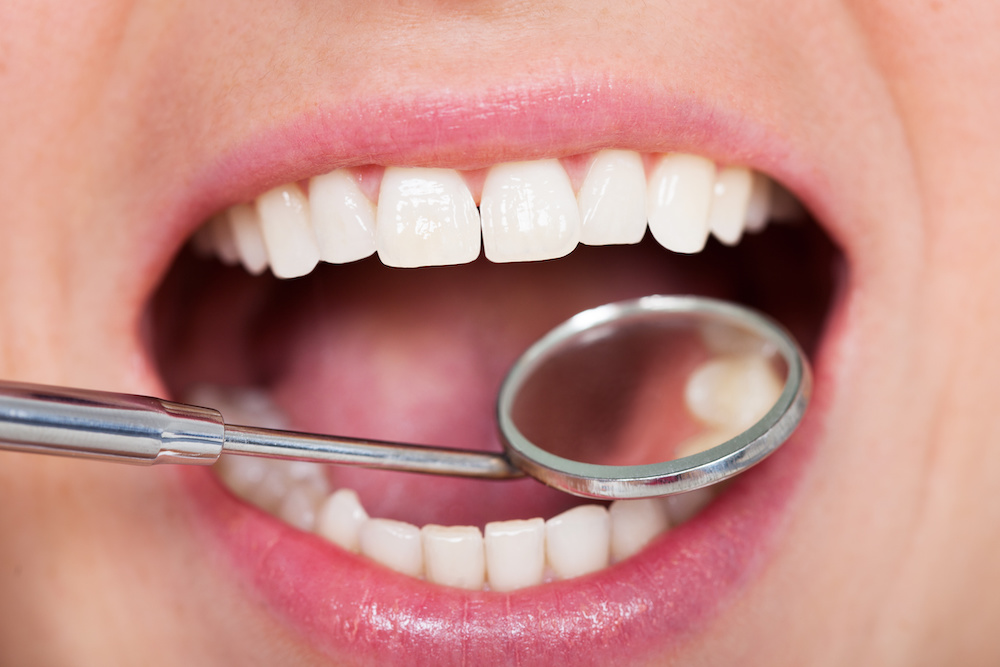 Cavity Treatment in Placentia - Tranquility Dental Arts, your Placentia dentist