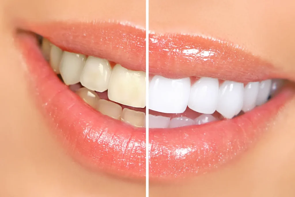 Tooth Whitening in Placentia - Tranquility Dental Arts, your Placentia dentist