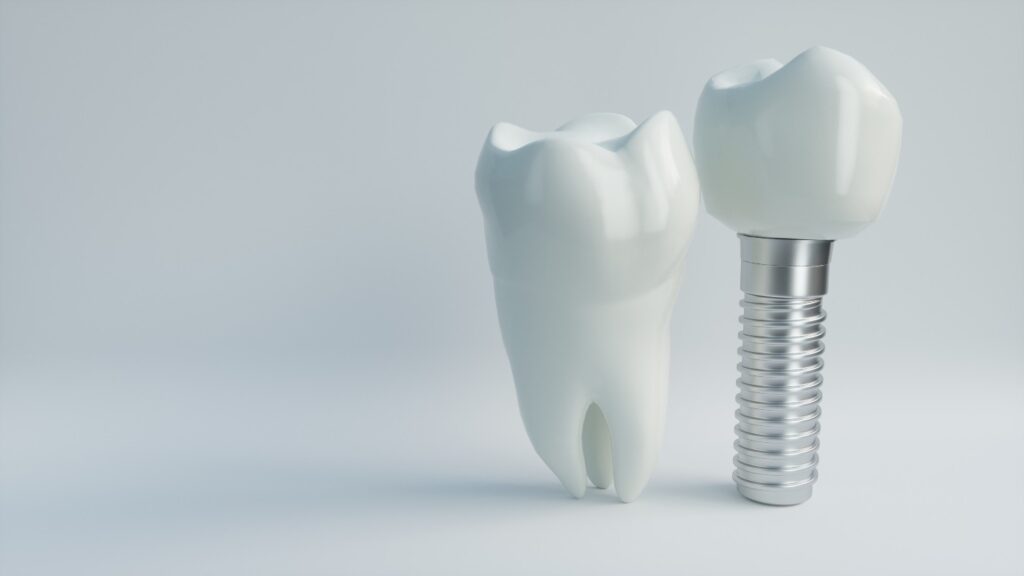 Dental Implants - Tranquility Dental Arts, your dentist in Placentia, CA