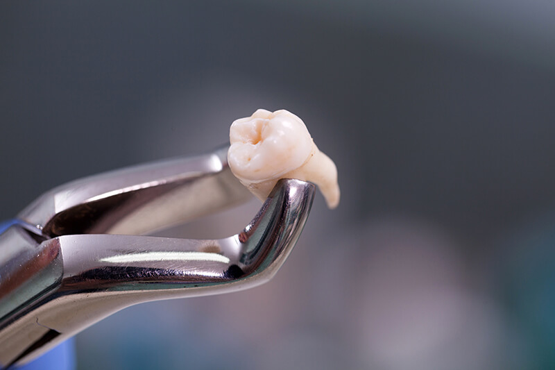 Tooth Extractions - Tranquility Dental Arts, your dentist in Placentia, CA
