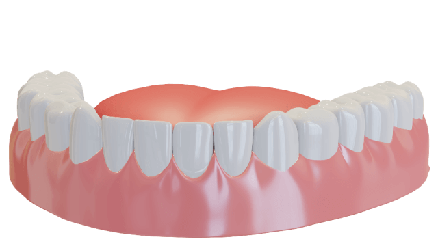 Veneers - Tranquility Dental Arts, your dentist in Placentia, CA