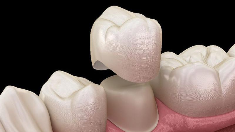 What is a dental crown? Tranquility Dental Arts, your Placentia dentist